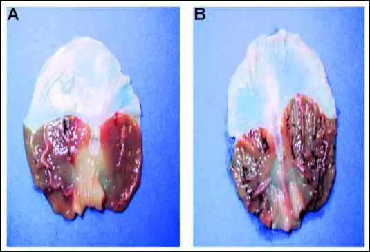 Calcified pineal gland